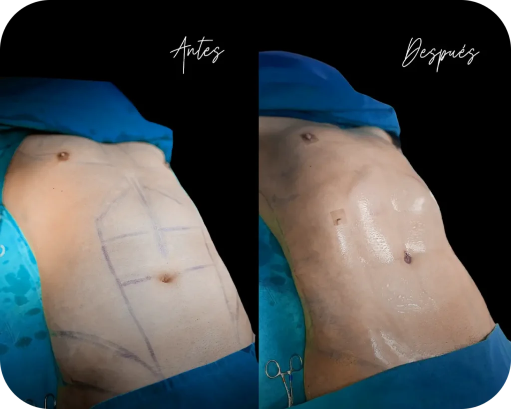 Lipo Soft Definition