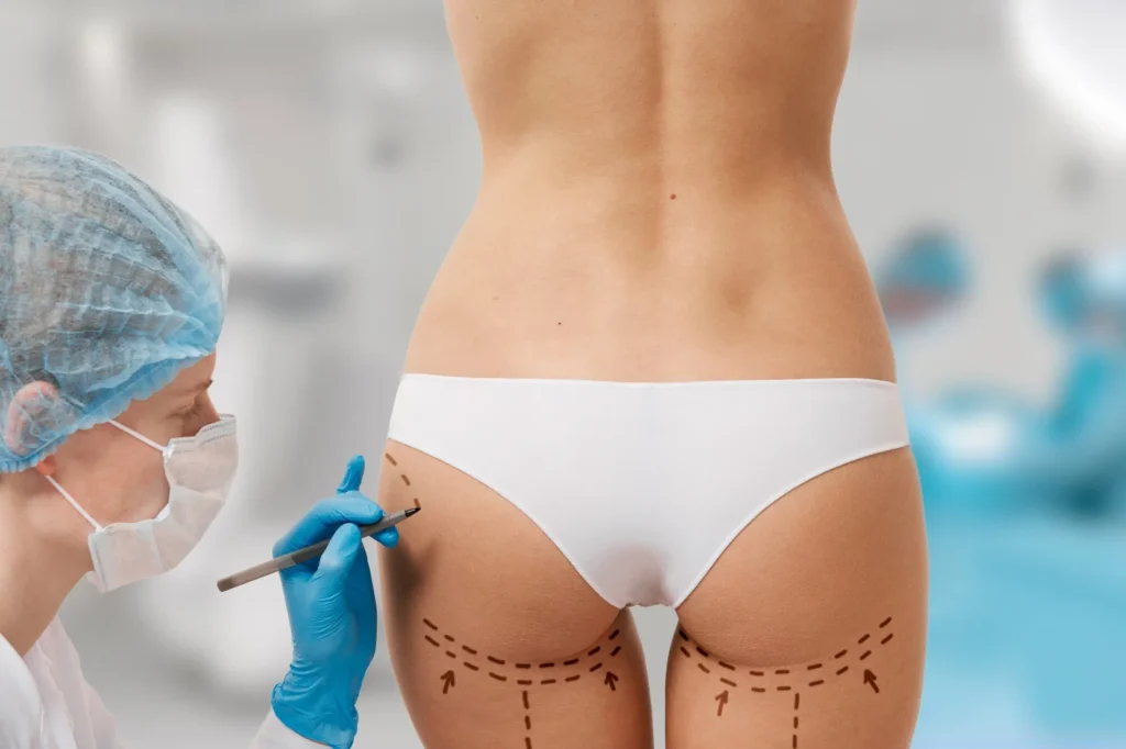 Lipotransferencia de Glúteos